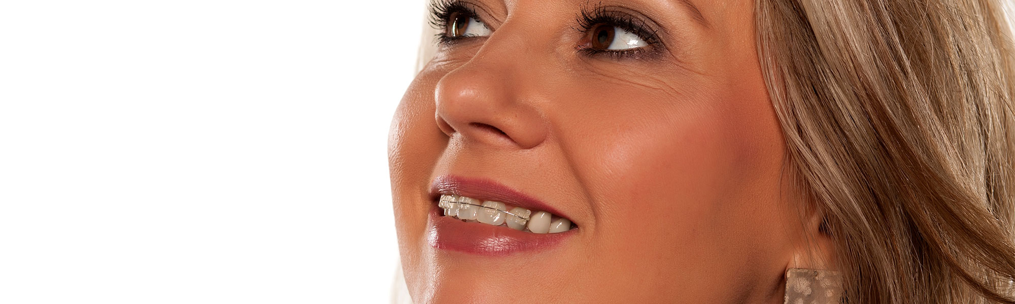Porcelain Ceramic Braces Oxnard CA