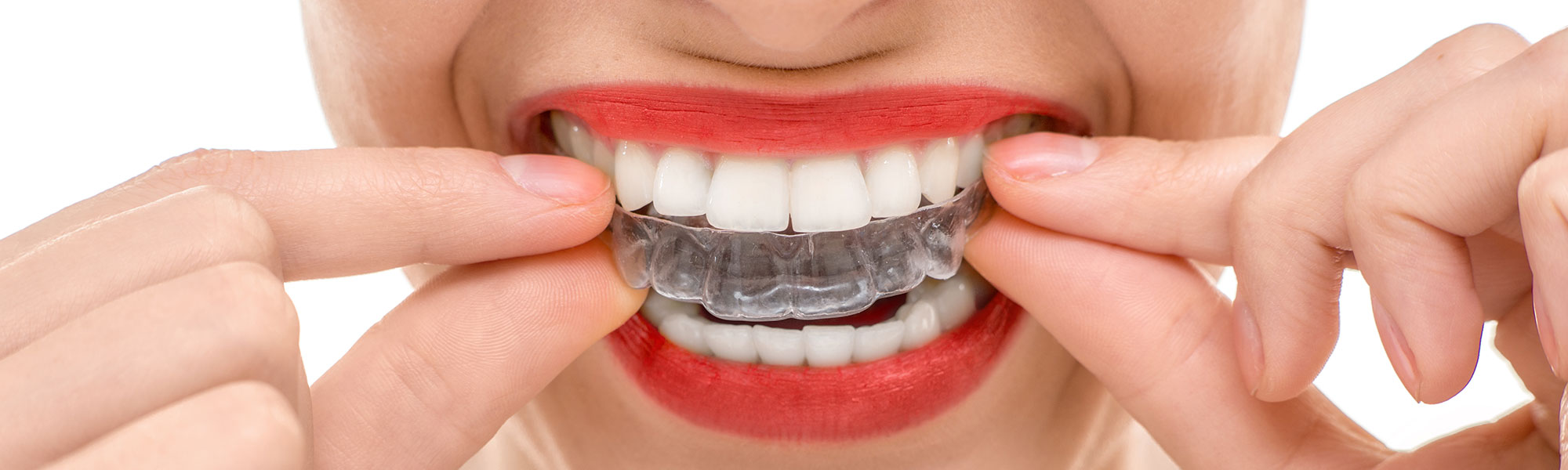 Orthodontic Retainers Long Beach CA