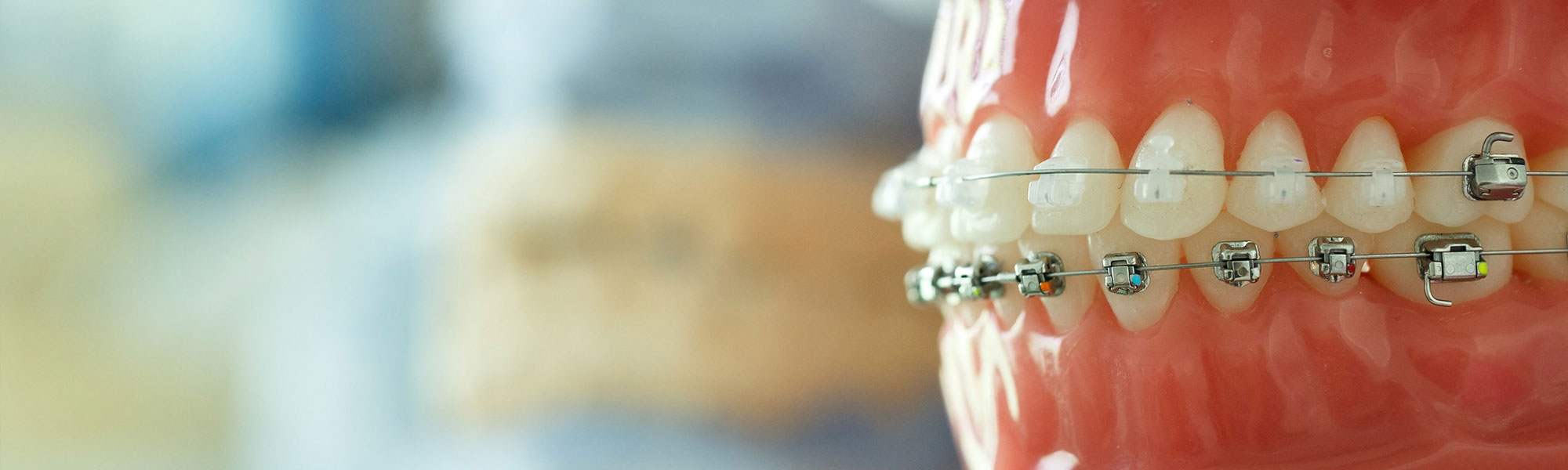 Ceramic Braces Long Beach CA