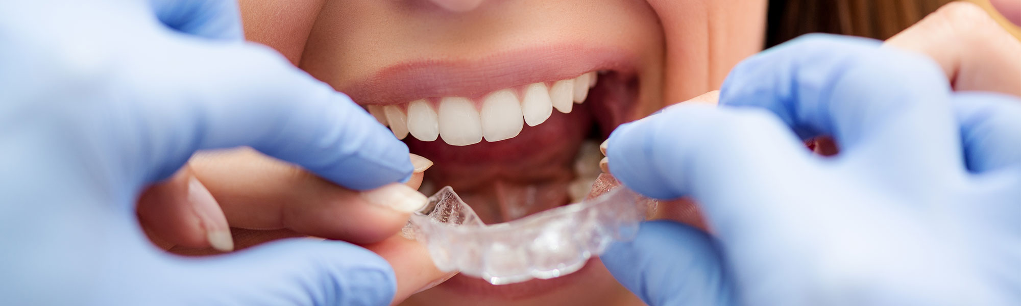 Invisalign Long Beach CA
